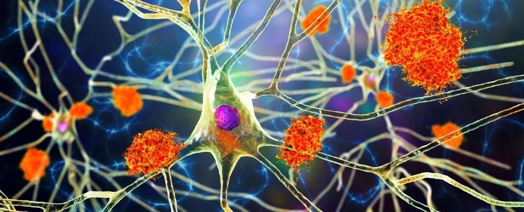 A Study of 500,000 Medical Records Links Viruses to Alzheimer’s Again And Again : ScienceAlert