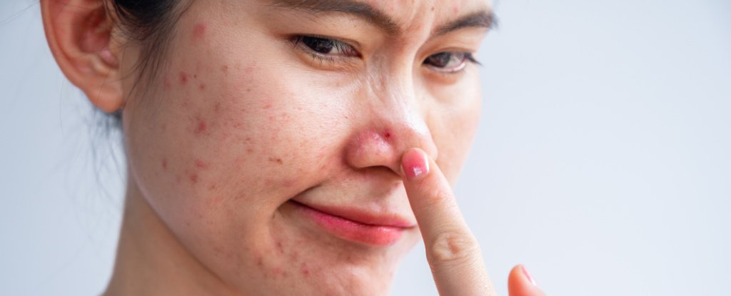 Bacteria Responsible For Acne Were Genetically Modified to Treat It Instead ScienceAlert
