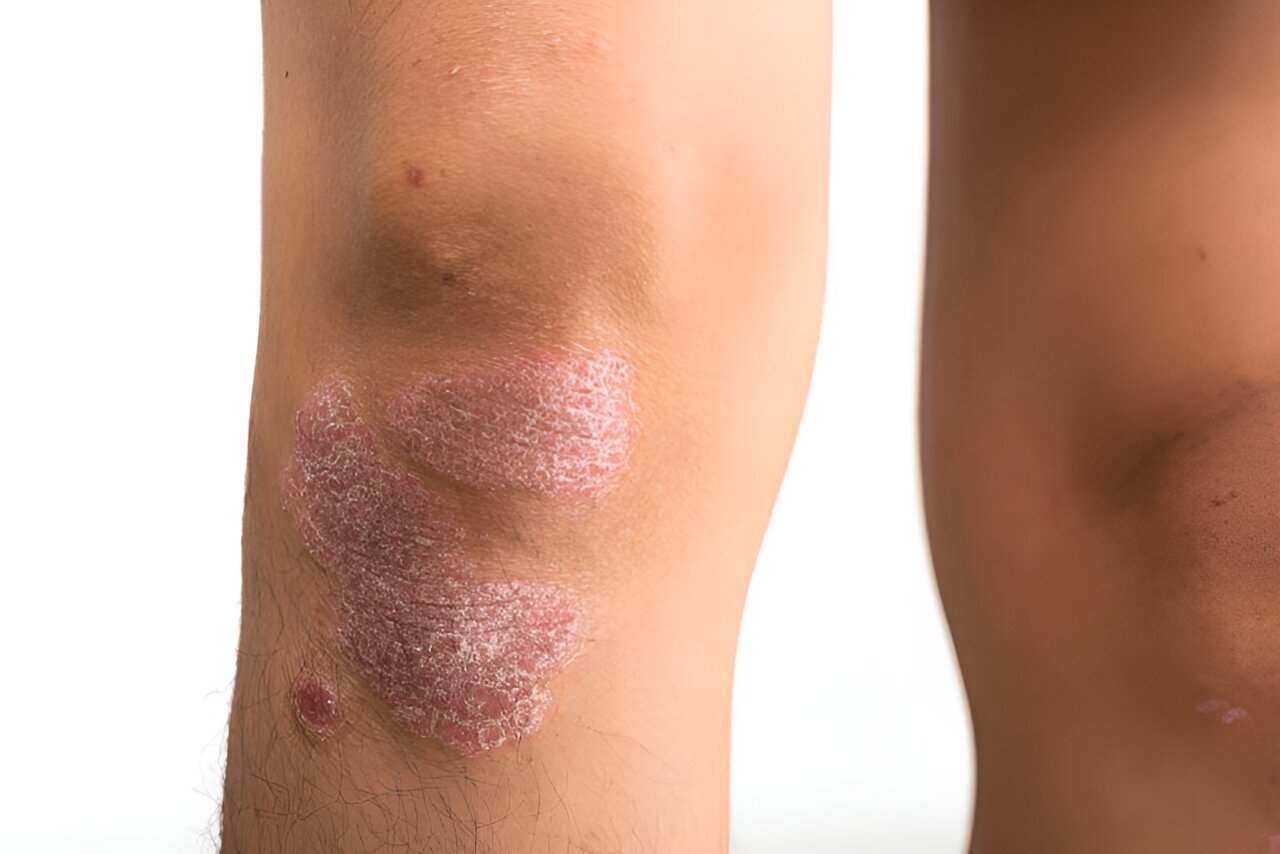 Biological agent trials for psoriasis rarely include patient images