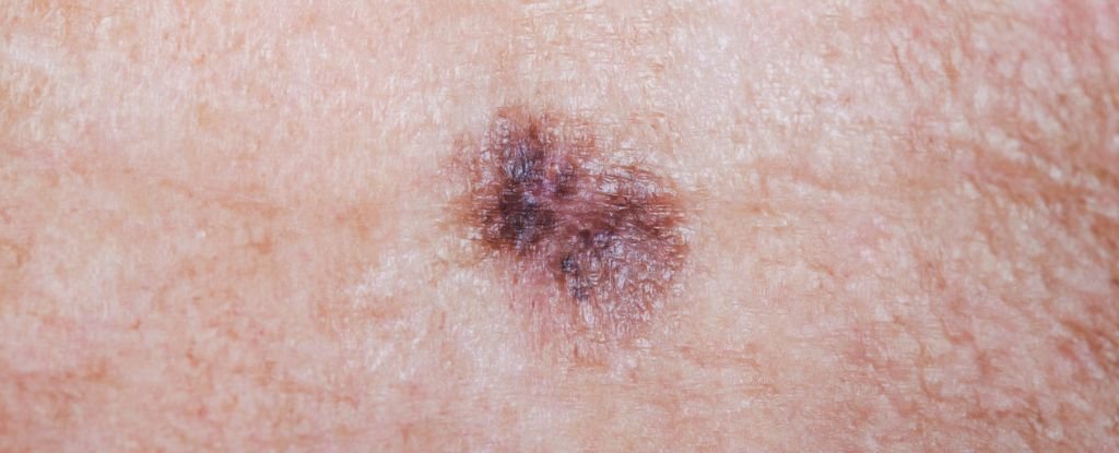 Powerful New Skin Cancer Therapy Cuts Risk of Death by Half ScienceAlert