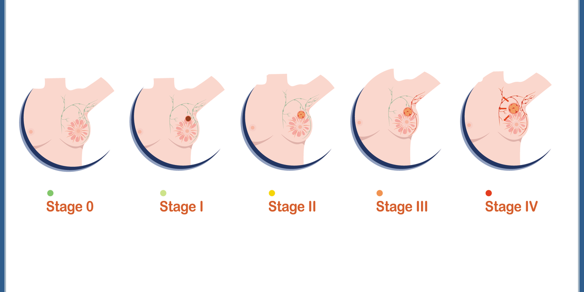 Stages of Breast Cancer HealthyWomen