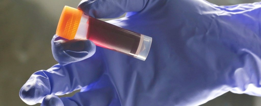 Your Blood Type Affects Your Risk of Early Stroke, Scientists Discover : ScienceAlert