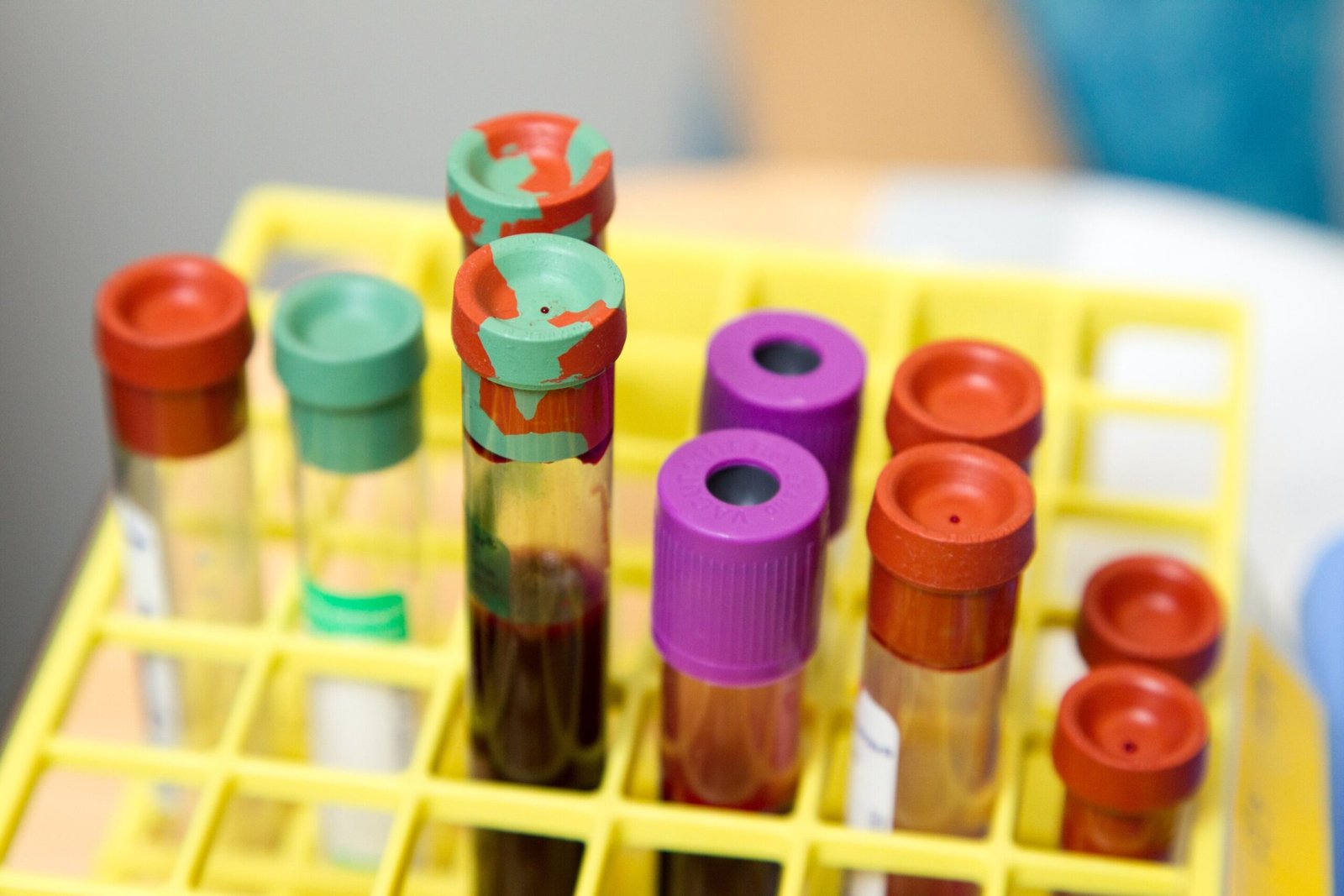 Alzheimer’s blood test found to perform as well as FDA-approved spinal fluid tests