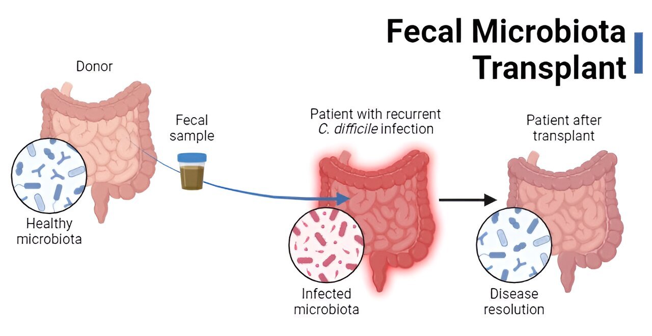 Fecal microbiota transplants Past present and future