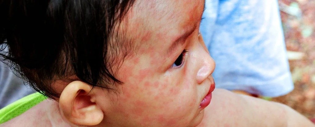 Measles Cases Soaring Worldwide as WHO Reports Alarming 45 Fold Rise in Europe ScienceAlert