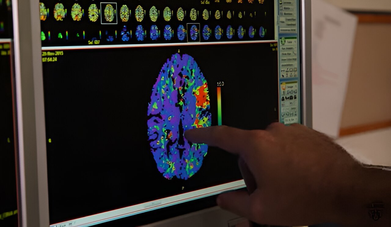 Video: What is vascular dementia?