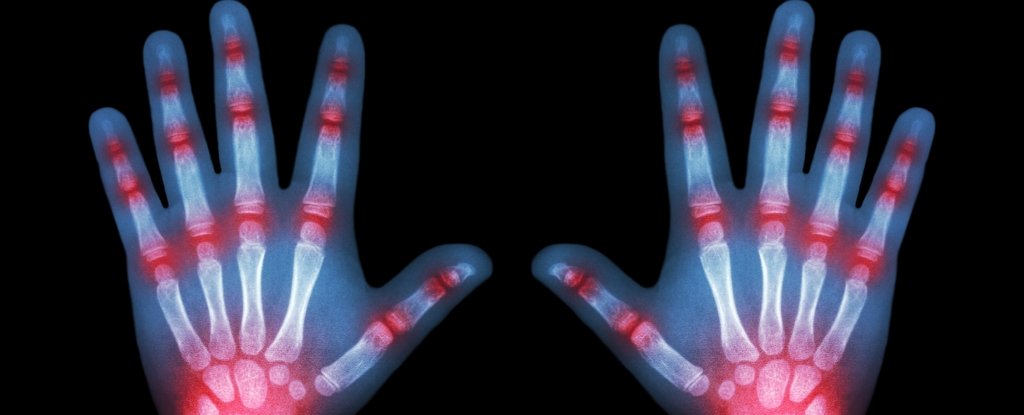 Arthritis Affects Thousands of Kids, And One Piece of Advice Is Crucial : ScienceAlert