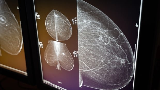 BC patients worry as breast cancer screening wait times climb