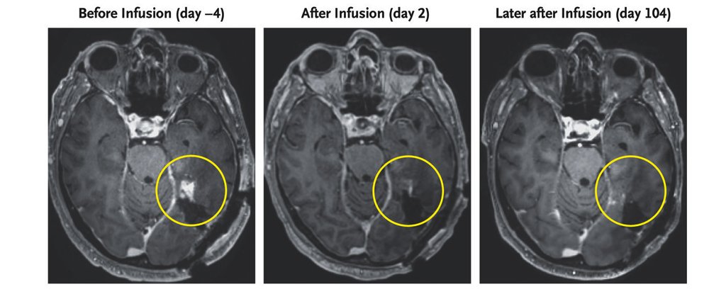 Breakthrough Therapy Obliterates Deadly Brain Tumor in Days : ScienceAlert