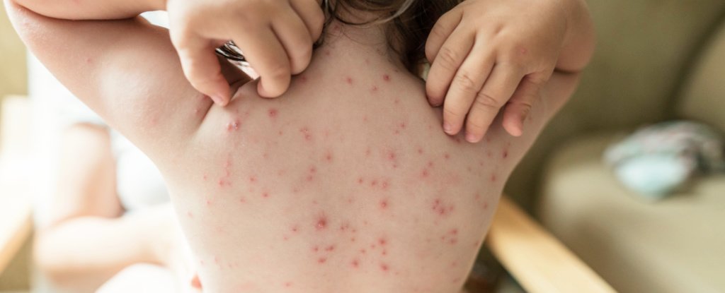 Half of All Suspected Chickenpox Cases in The US Could Be Something Else Entirely ScienceAlert