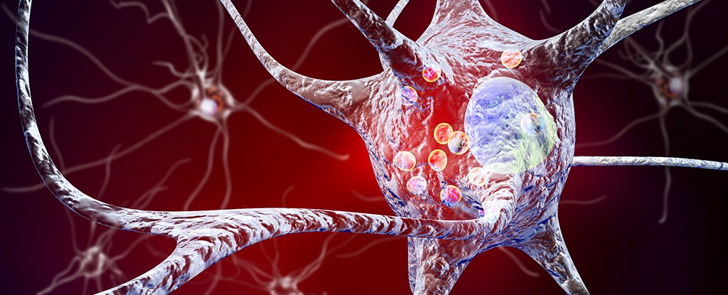 Parkinson’s Drug Reduces Disease Markers in Breakthrough Trial : ScienceAlert