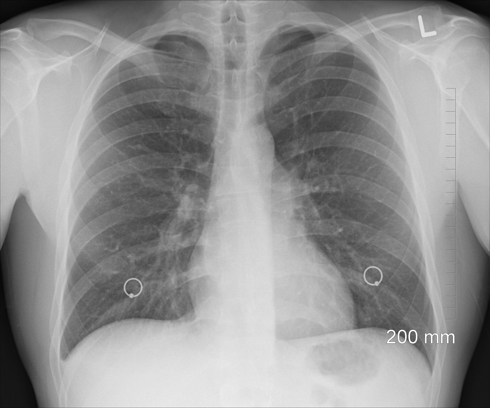 Severe lung infection during COVID 19 can cause damage to the heart