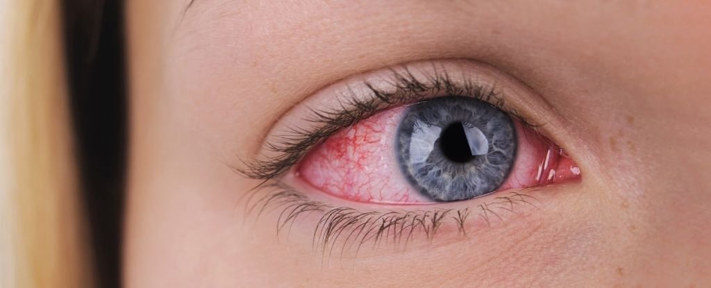 Eye Infections Can Be Far More Serious Than You Realize, Expert Warns : ScienceAlert