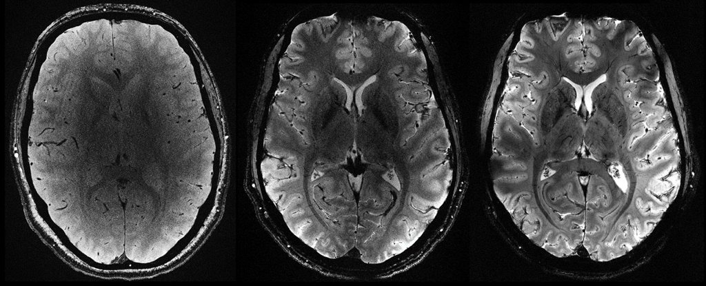 First Images of Human Brain From World’s Most Powerful MRI Revealed : ScienceAlert