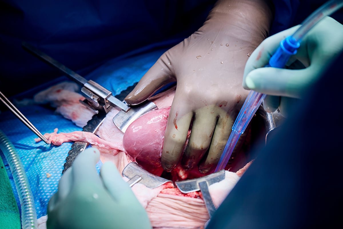 She was too sick for a traditional transplant. So she received a pig kidney and a heart pump