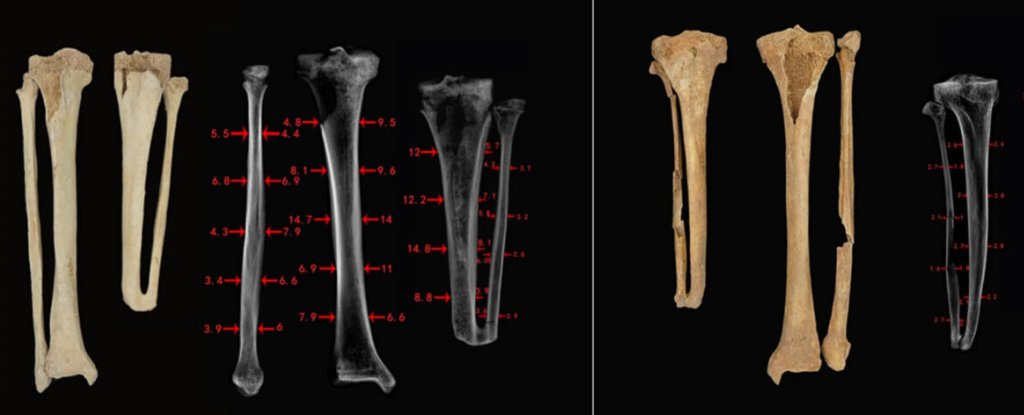 2500 Year Old Skeletons With Matching Injuries Reveal Grisly Punishments in Chinas Past ScienceAlert