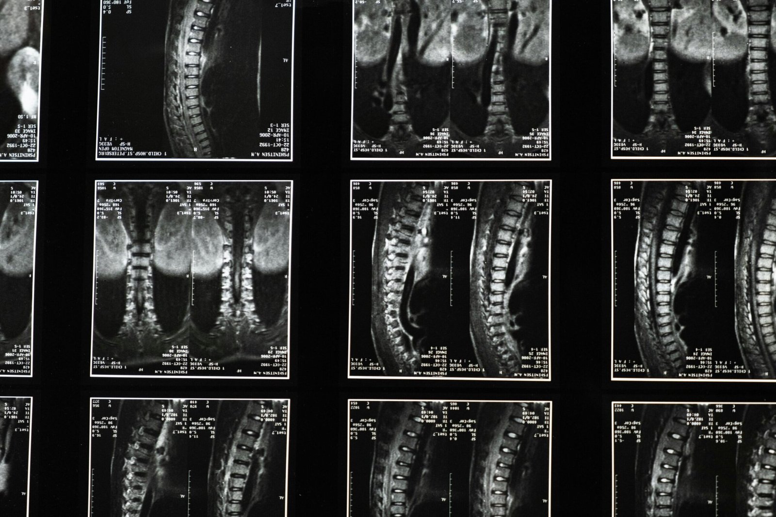Arm fat may reveal women and men at risk of spinal fracture