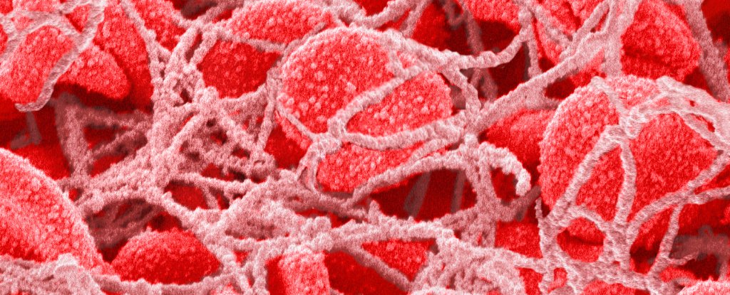 Microplastics Found in Blood Clots in Heart Brain And Legs ScienceAlert