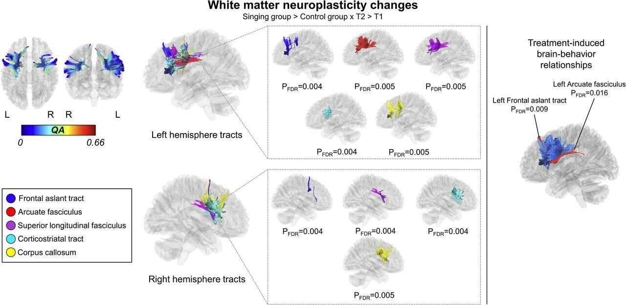 Neuroplasticity study shows how singing rehabilitates speech production in post stroke aphasia