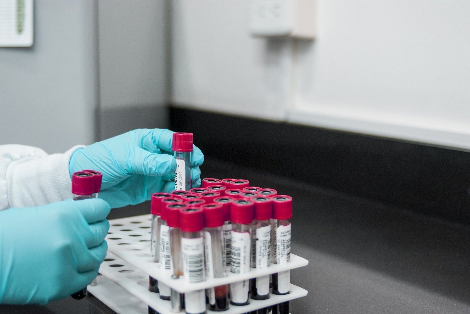 New blood test for stroke detection combines blood based biomarkers with a clinical score