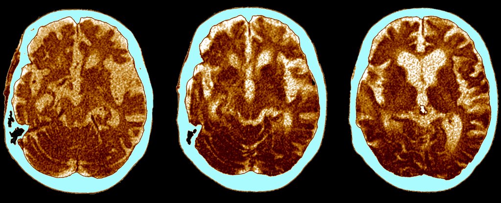 Some People Are Strangely Resistant to Alzheimer’s. Here’s What Makes Them Different. : ScienceAlert