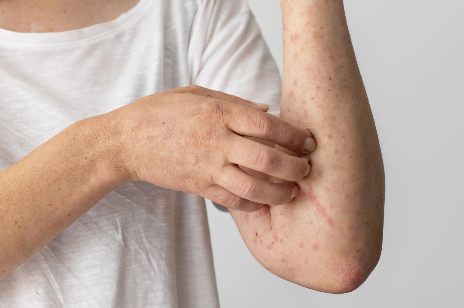 Vulnerability To Stress In Adolescence Raises Men’s Risk Of Psoriasis Later: Study