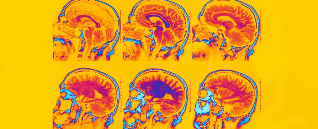 Brain Scans Identify Six Distinct Types of Depression And Anxiety : ScienceAlert