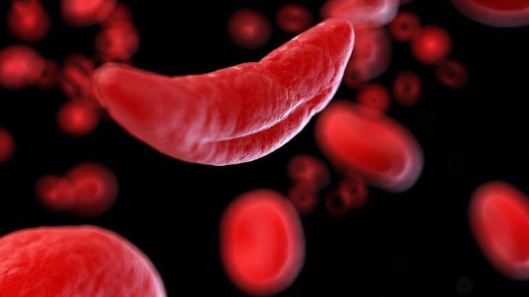 Novel gene-editing therapy continues to show positive results in sickle cell patients