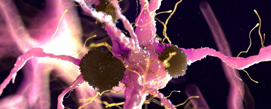 Parkinson’s Discovery Suggests We May Already Have an FDA-Approved Treatment : ScienceAlert