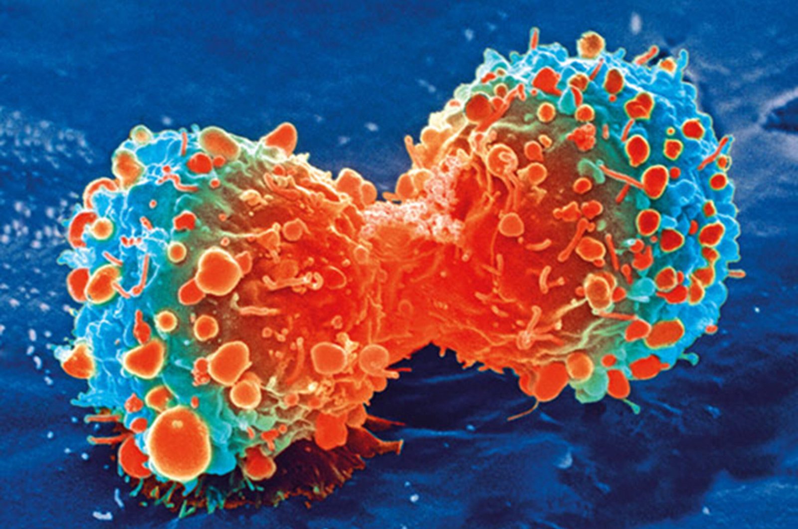 Ultrasensitive liquid biopsy tech spots cancer earlier than standard methods