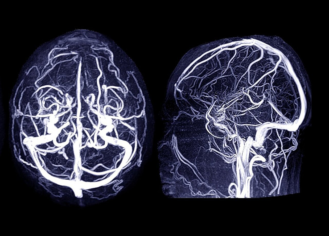 What is a cerebral aneurysm and what are the signs