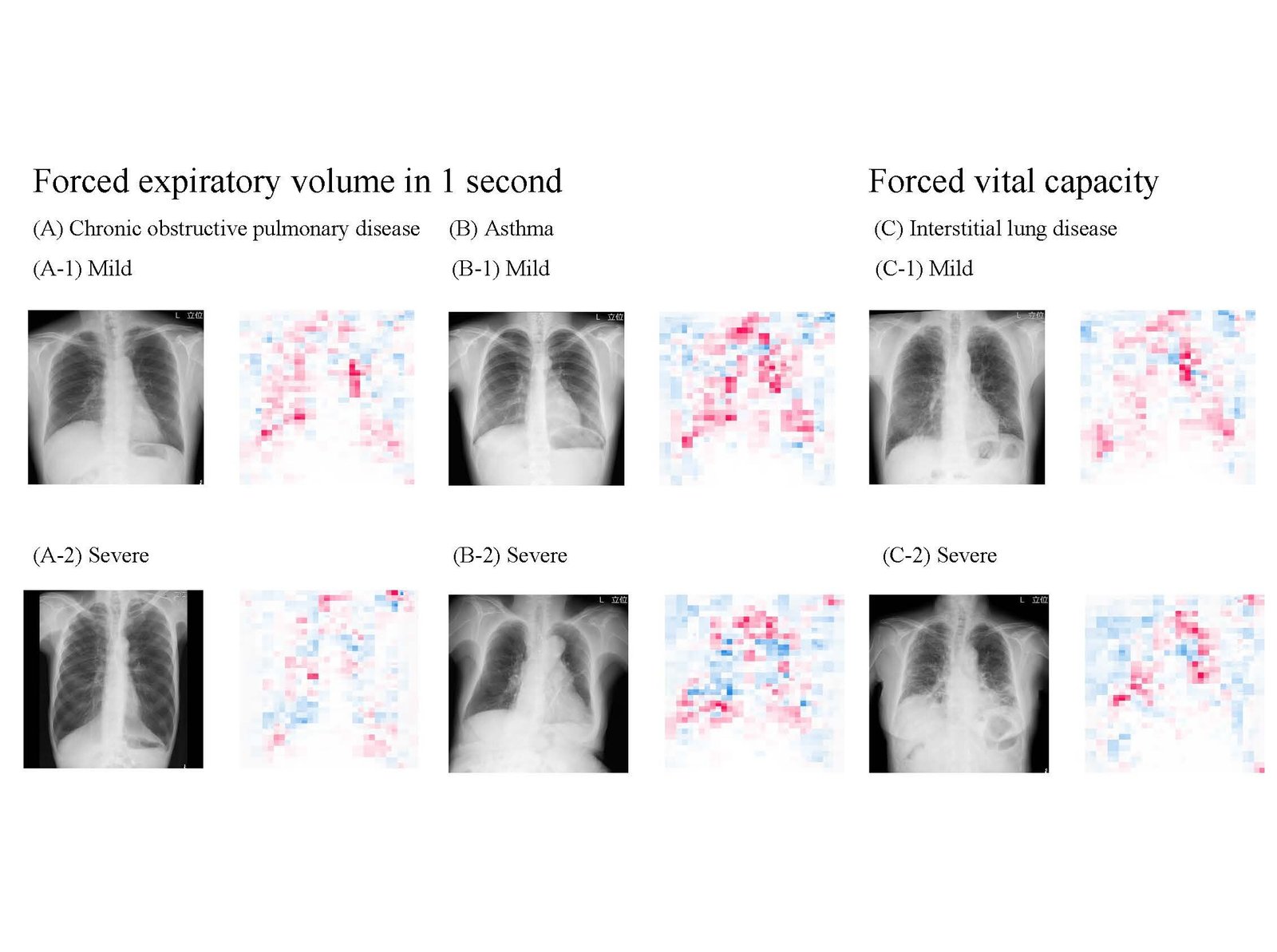 Highly accurate AI model can estimate lung function just by using chest X rays