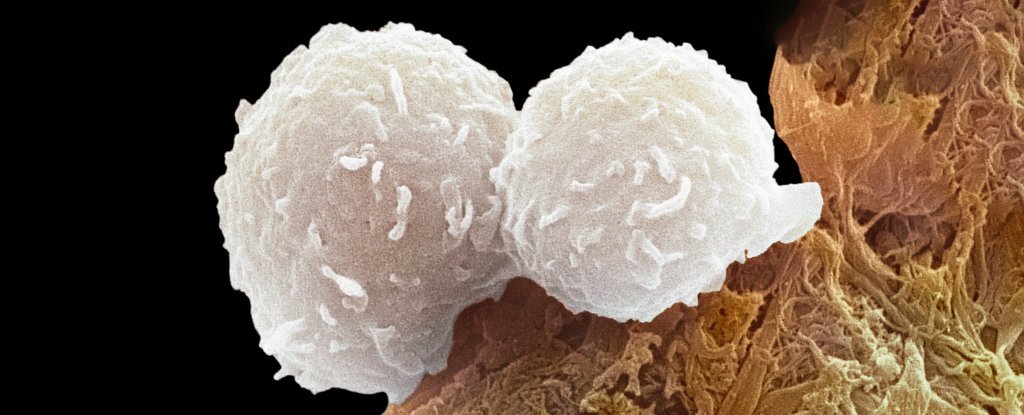 Root Cause of Lupus Found in a Tug of War Over a Critical White Cell ScienceAlert