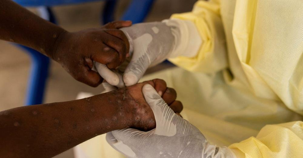 Africa public health body declares mpox emergency