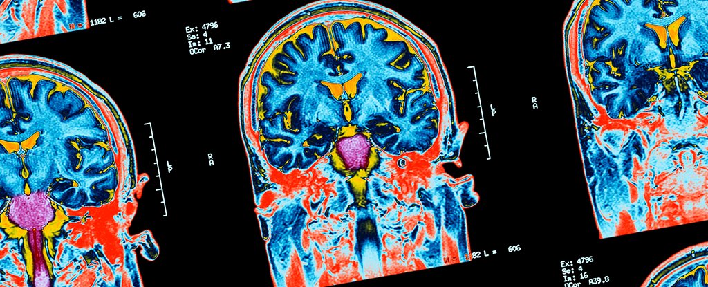 Hidden Consciousness Detected in 25% of Unresponsive Patients Tested : ScienceAlert