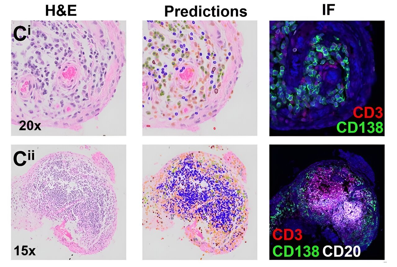 Machine learning helps identify rheumatoid arthritis subtypes