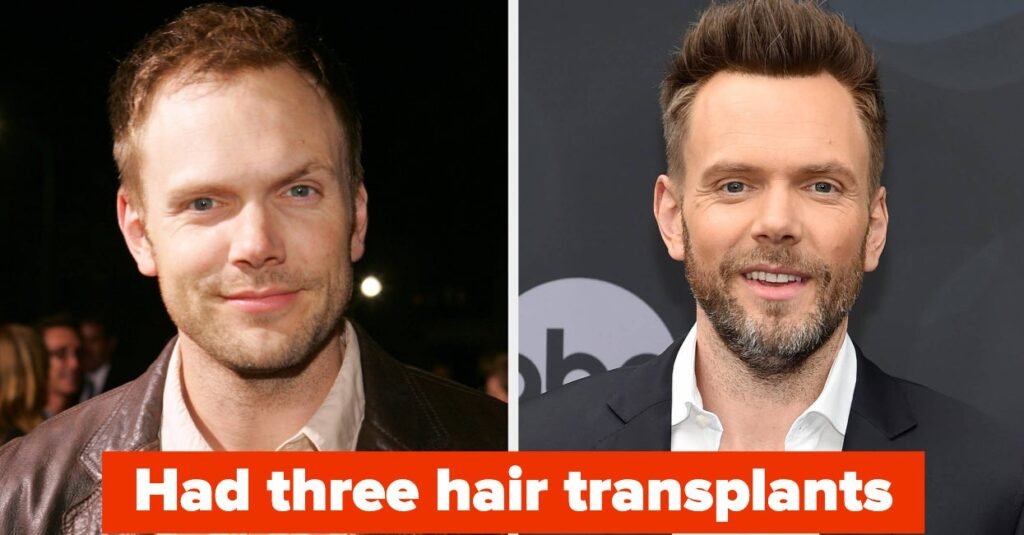 Male Celebs Discuss Hair Transplants And Wigs