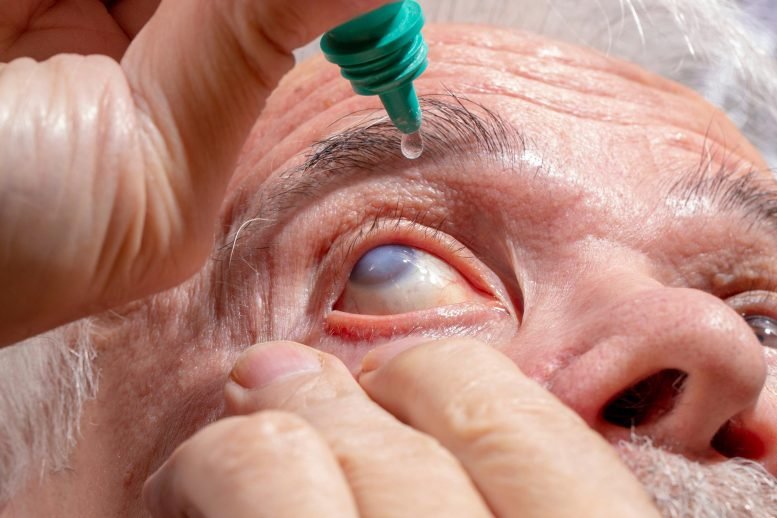 Eye Disease Glaucoma