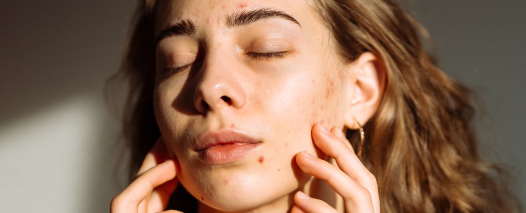 Latest TikTok Acne Hack Could Put You at Serious Risk of Cancer : ScienceAlert