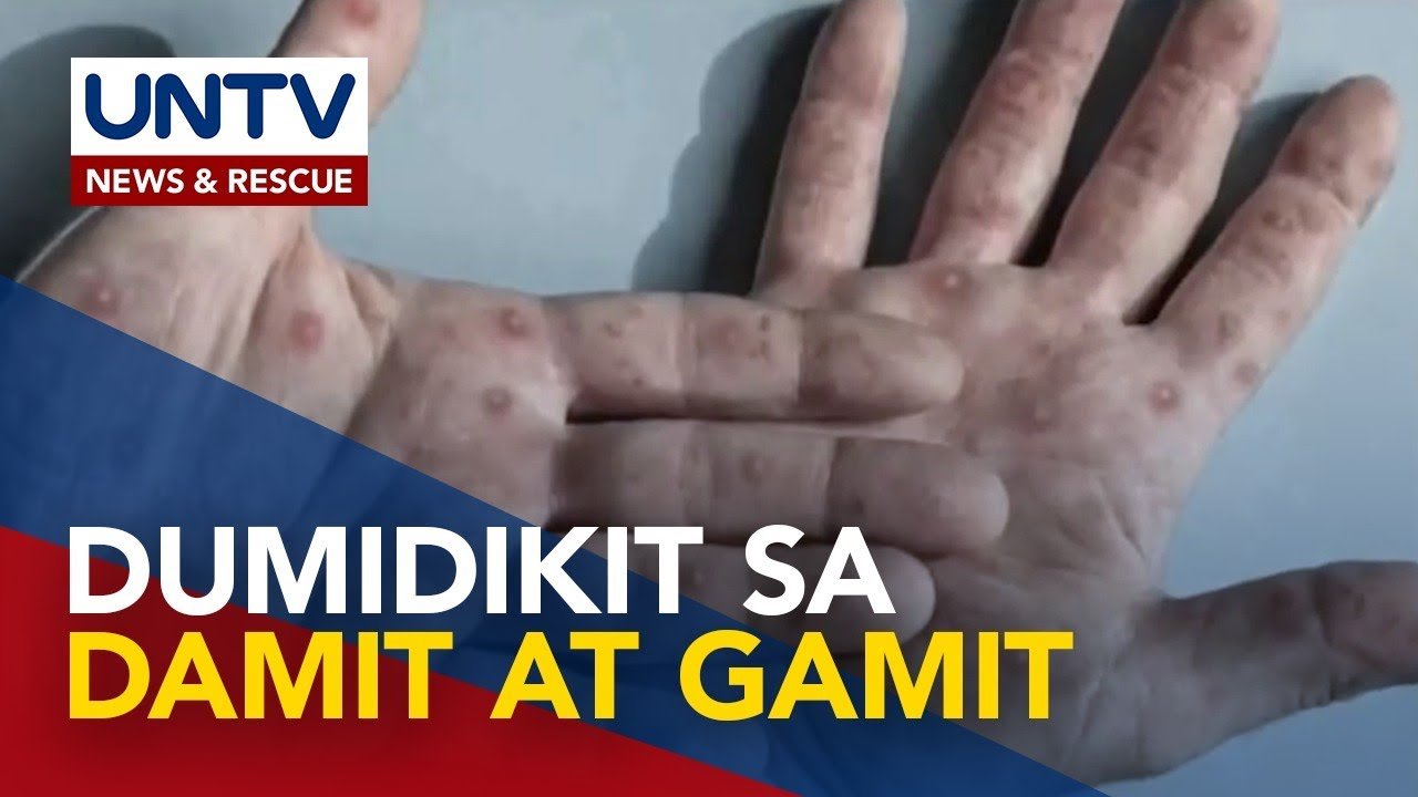 Mpox virus, maaaring makuha sa skin-to-skin at kontaminadong gamit; Sintomas, alamin!