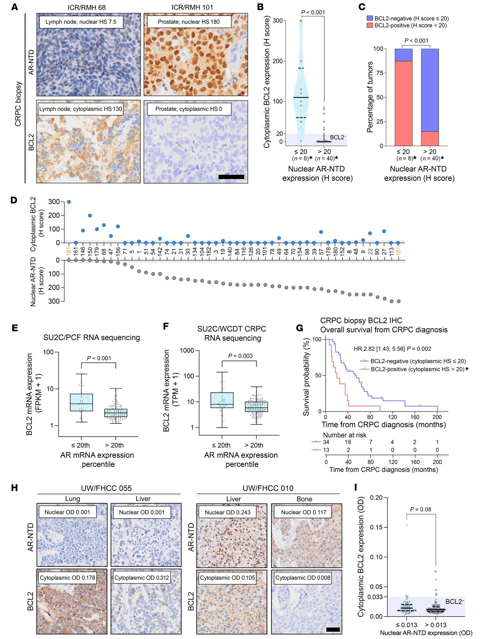 New drug target discovered for aggressive form of prostate cancer