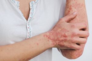 New research confirms link between perceived stress and psoriasis relapse