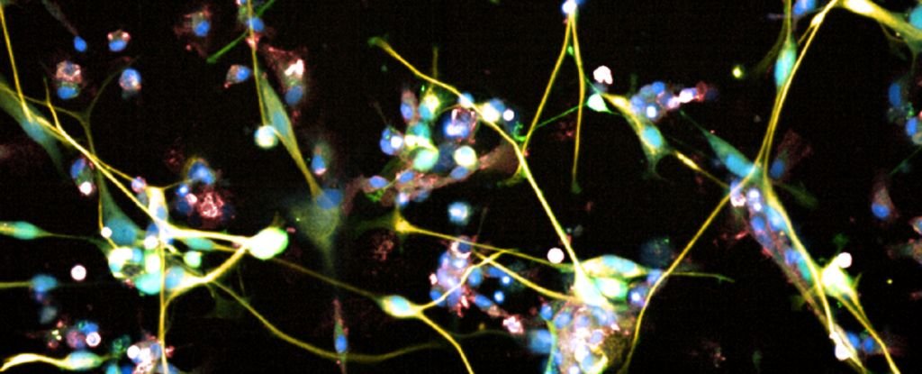 FDA-Approved Antidepressant Treats Incurable Brain Cancer in Preclinical Trial : ScienceAlert