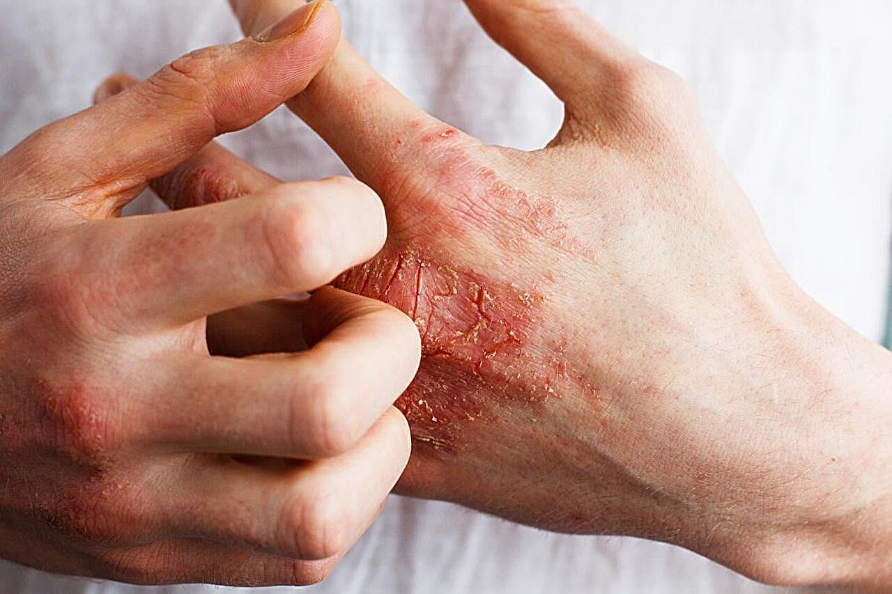 Long-term efficacy for lebrikizumab seen in moderate, severe eczema