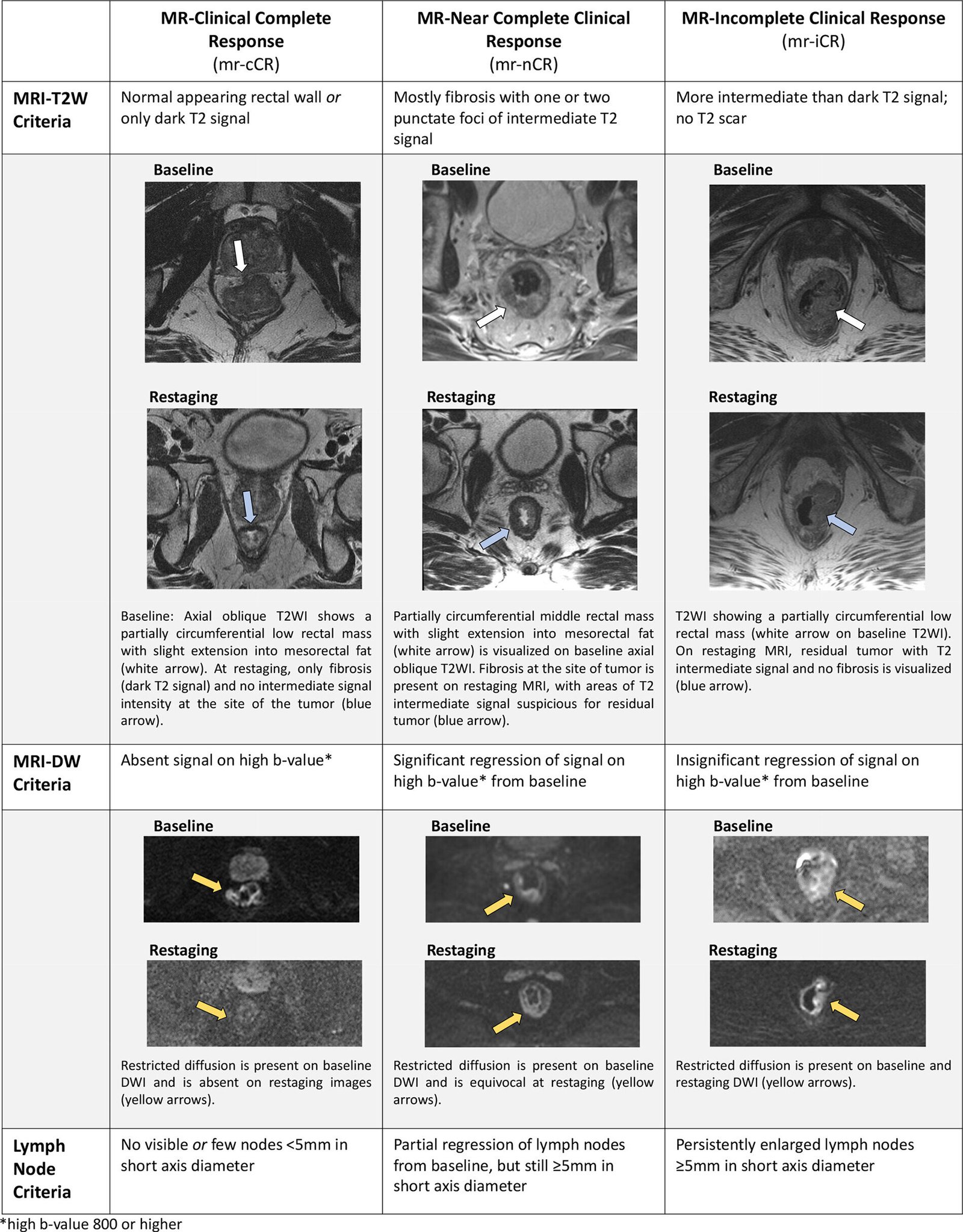 MRI can save rectal cancer patients from surgery, study suggests