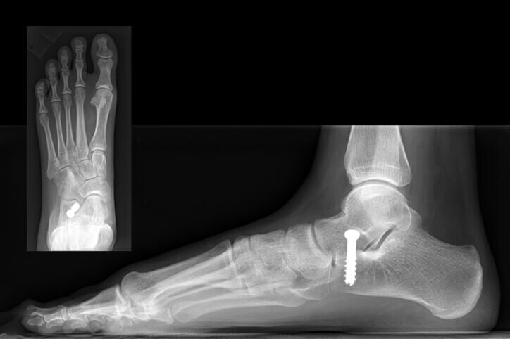 Novel procedure may bridge the treatment gap for symptomatic flexible flatfoot