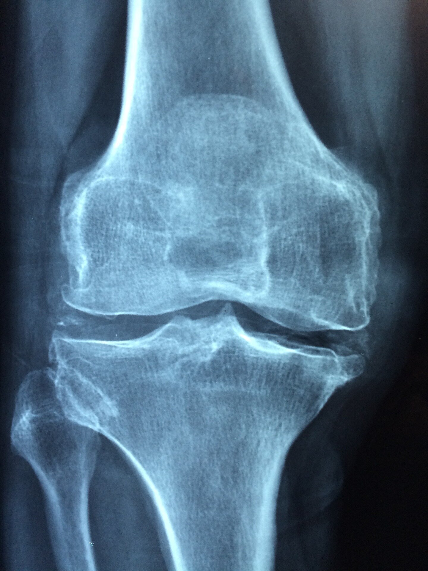 Protein blocking bone development could hold clues for future osteoporosis treatment