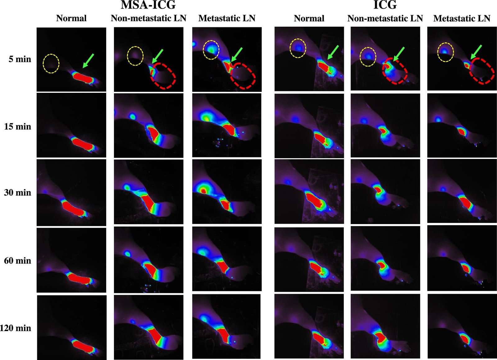 Researchers develop precision surgical technique for lymph node removal in endometrial cancer