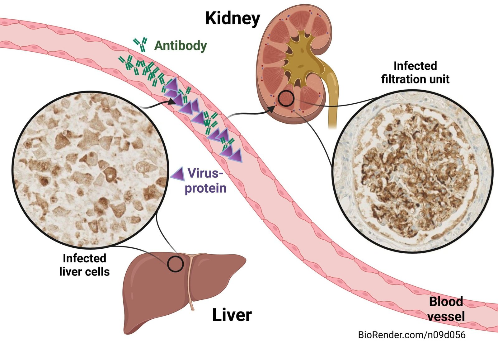 Unraveling the link between hepatitis and kidney damage