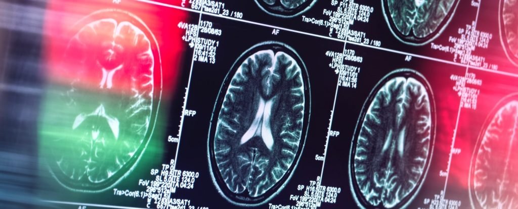 Alzheimer's May Not Actually Be a Brain Disease, an Expert Reveals : ScienceAlert